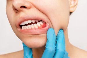 La acumulación de placa puede causar sangrado en las encías.