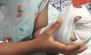 El caso más reciente de quemadura por uso de pólvora se registró en Yumbo. Un niño de 13 años resultó con lesiones en la mano izquierda por manipular una petaca.