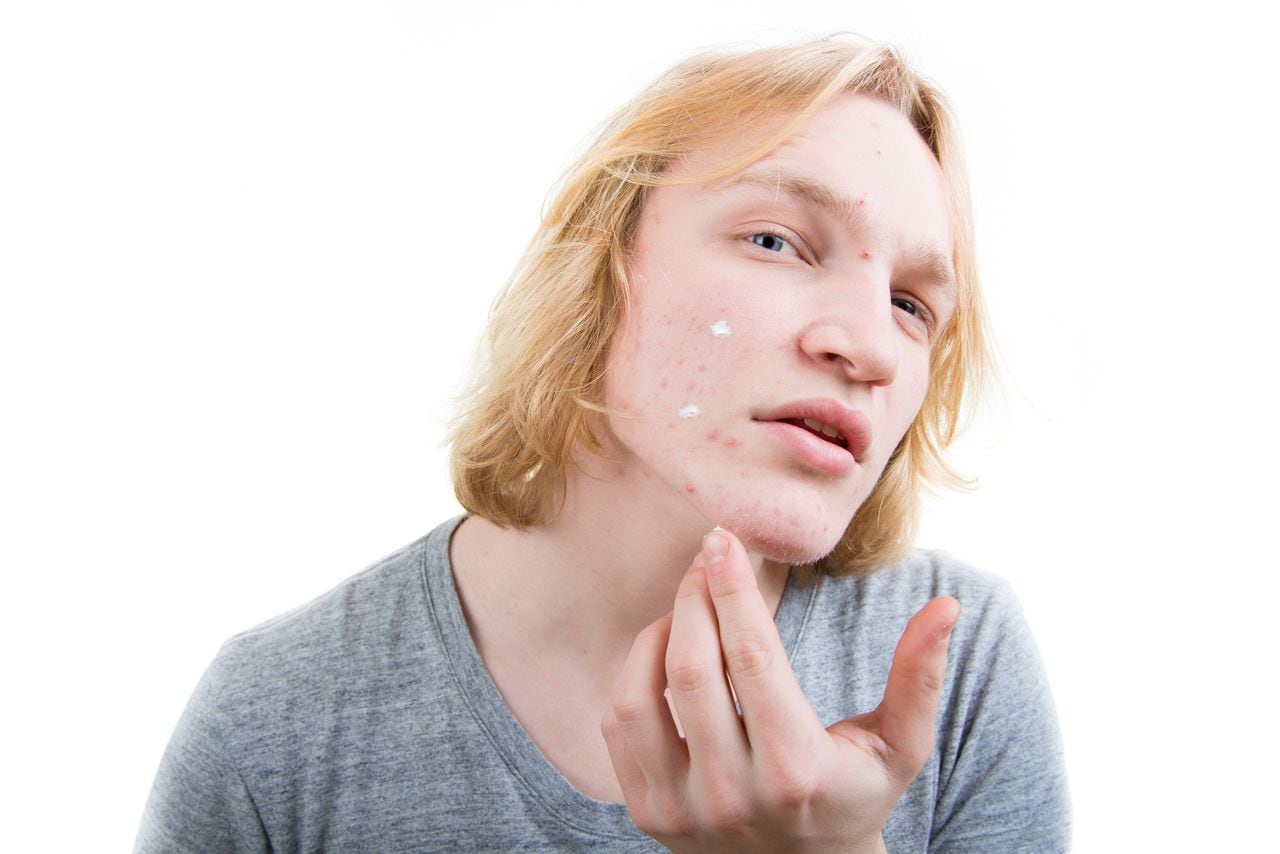 Se debate el papel de la pasta de dientes como solución rápida para el acné.