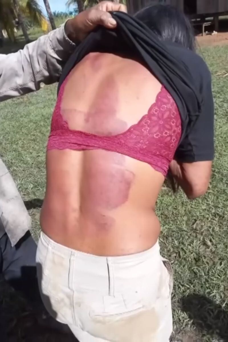 La comunidad tomó esta foto de la espalda de Magdalena, luego de haber sido golpeada con un machete por su esposo.