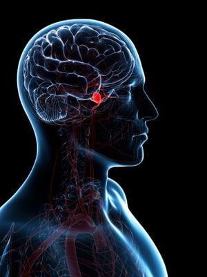 Un aneurisma cerebral es una enfermedad cerebrovascular que se caracteriza por una dilatación de la pared arterial que puede desencadenar en una rotura.