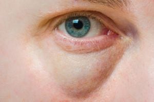 Aprenda a preparar remedios naturales que te ayudarán a reducir las antiestéticas bolsas bajo los ojos