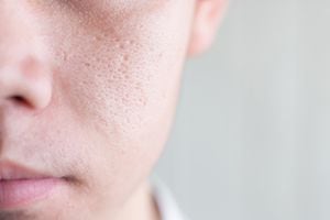 En ocasiones, los poros abiertos son señal de malos cuidados a la piel.