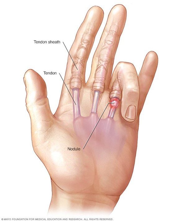 El dedo en gatillo sucede cuando el dedo o el pulgar pueden atascarse y quedar en una posición doblada o recta.