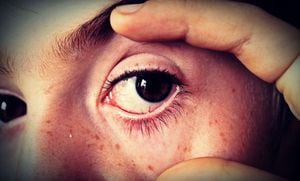 Los espasmos del párpado, también conocidos como mioquimia, son generalmente inofensivos y suelen desaparecer por sí solos en unos pocos días o semanas.