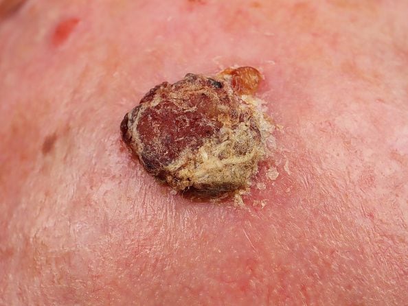Parietal fronto Dubreuilh melanoma in an 81-year-old man. (Photo by: GIRAND/BSIP/Universal Images Group via Getty Images)