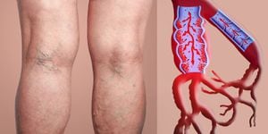 La mala circulación en las piernas puede ocasionar coágulos. Los grupos sanguíneo a y B son los más propensos a enfrentar esta afección.