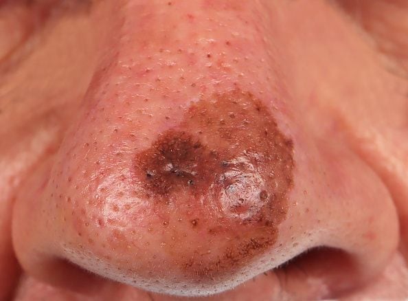 Melanoma of Dubreuilh of the tip of the nose in a 72 year old man. (Photo by: GIRAND/BSIP/Universal Images Group via Getty Images)