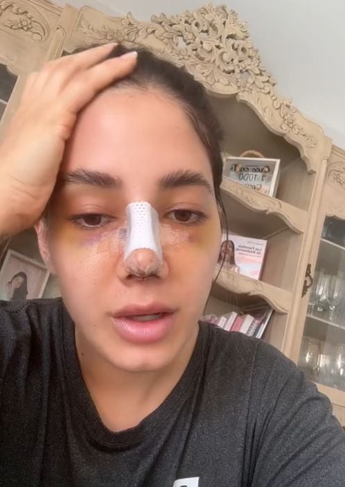 Mujer se volvió viral en TikTok tras compartir su experiencia tras realizarse la rinoplastia.