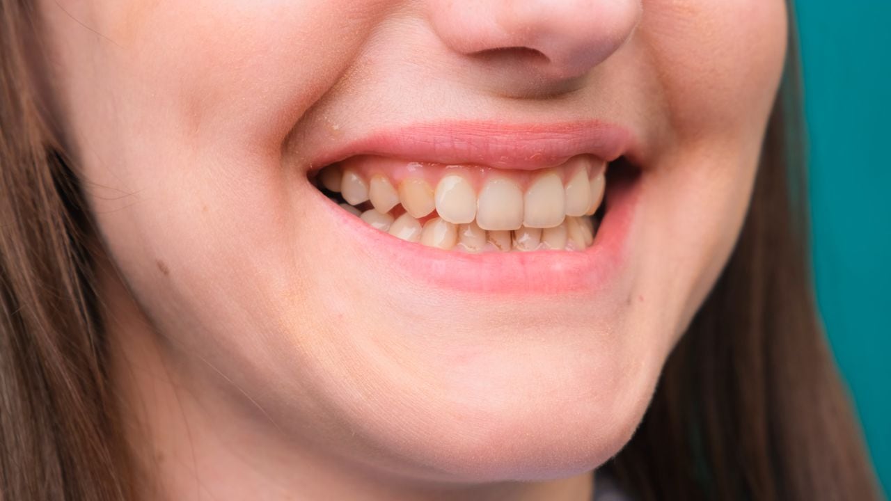 Los dientes amarillos se pueden generar por múltiples factores.