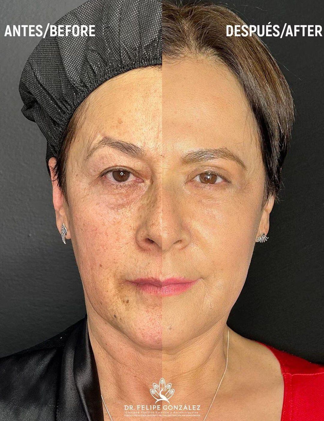 El antes y después de la actriz de 54 años tras someterse a una serie de procedimientos quirúrgicos.