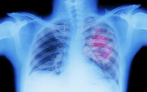 El cáncer de pulmón genera pérdida de peso y dolor en la espalda.