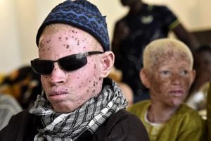 A Senegalese albinos man attends the International Albinism Awareness Day on June 13, 2017, at the cultural centre Douta Seck in Dakar. Albinism is a hereditary genetic condition which causes a total absence of pigmentation in the skin, hair and eyes. In some countries albinos are kidnapped and their body parts hacked off for use as charms and magical potions in the belief that they bring wealth and good luck especially during elections even if there is no official reports. (Photo by SEYLLOU / AFP)