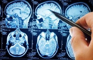 A pesar de que el tratamiento precoz de los tumores cerebrales puede mejorar los resultados, los pacientes deben informar a su médico de cualquier síntoma neurológico inusual.
