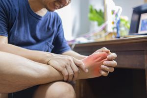 La gota es un fuerte dolor e inflamación en el dedo gordo del pie como consecuencia de niveles elevados de ácido úrico.