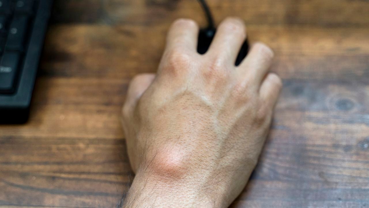 Ganglion cyst on man's hand. Hand holding computer mouse.