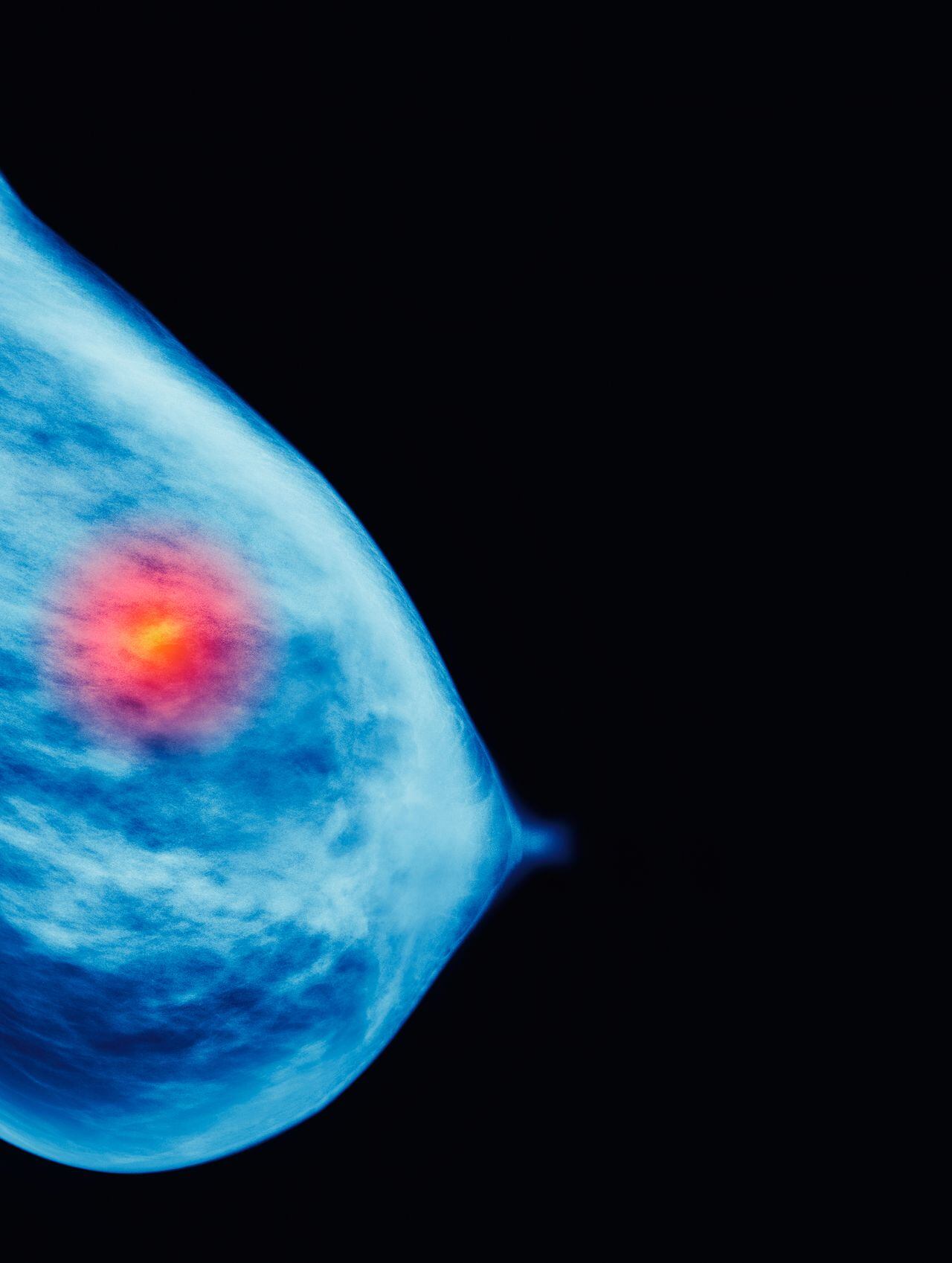 Mamografia - Cáncer de seno