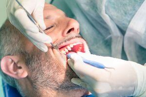 Los cálculos en los dientes aparecen como consecuencia de una mala higiene bucal.