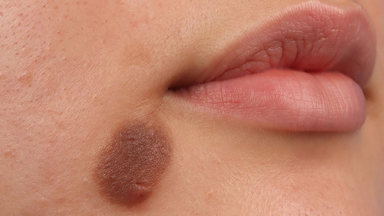Congenital nevus of the cheek in a 20-year-old woman. (Photo by: GIRAND/BSIP/Universal Images Group via Getty Images)
