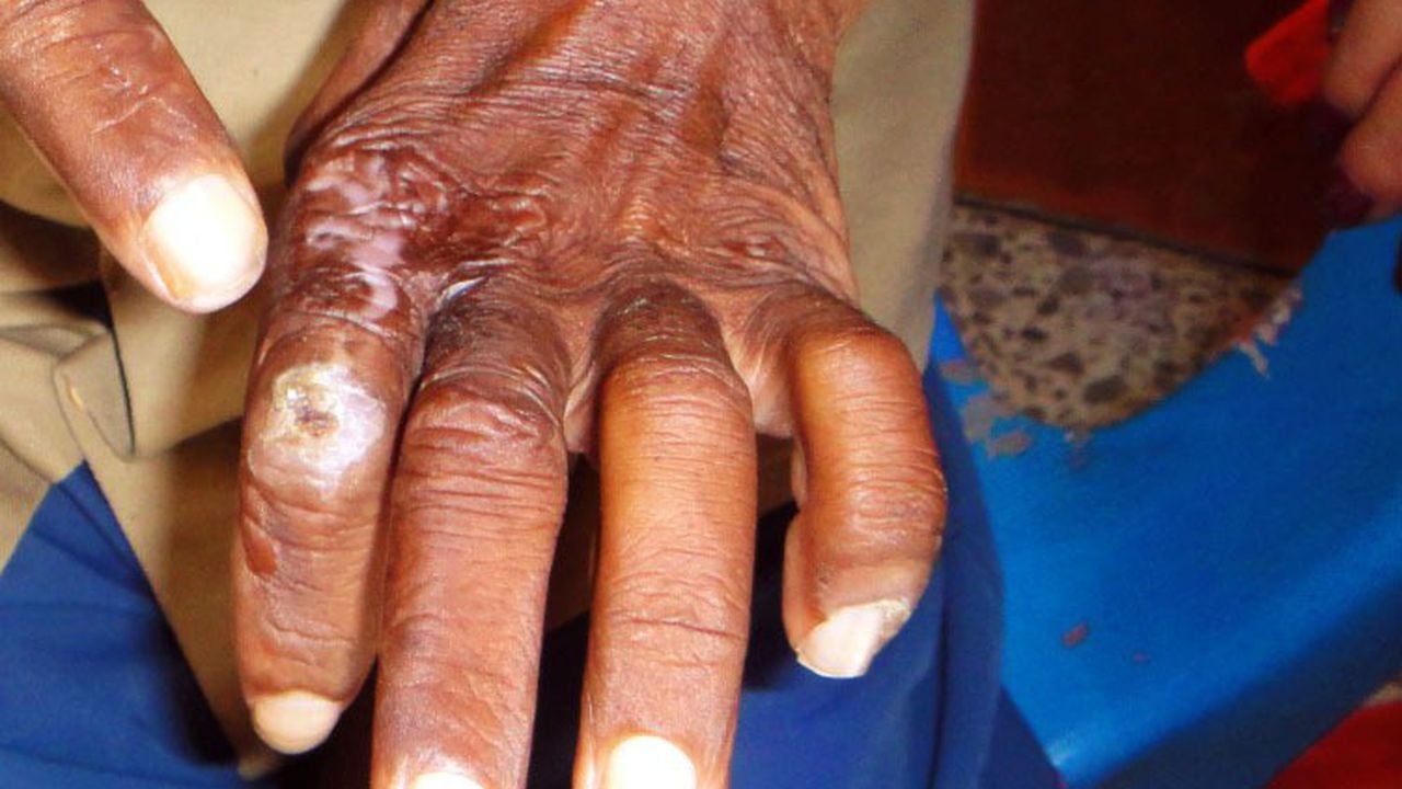Actualmente hay 37 casos de lepra en el departamento que están bajo seguimientos por las autoridades en salud.