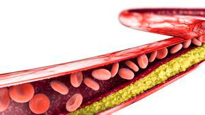 Los altos niveles de colesterol pueden inducir a enfermedades cardíacas.