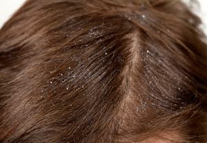 Remedios naturales para la caspa: Su camino hacia un cabello deslumbrante.