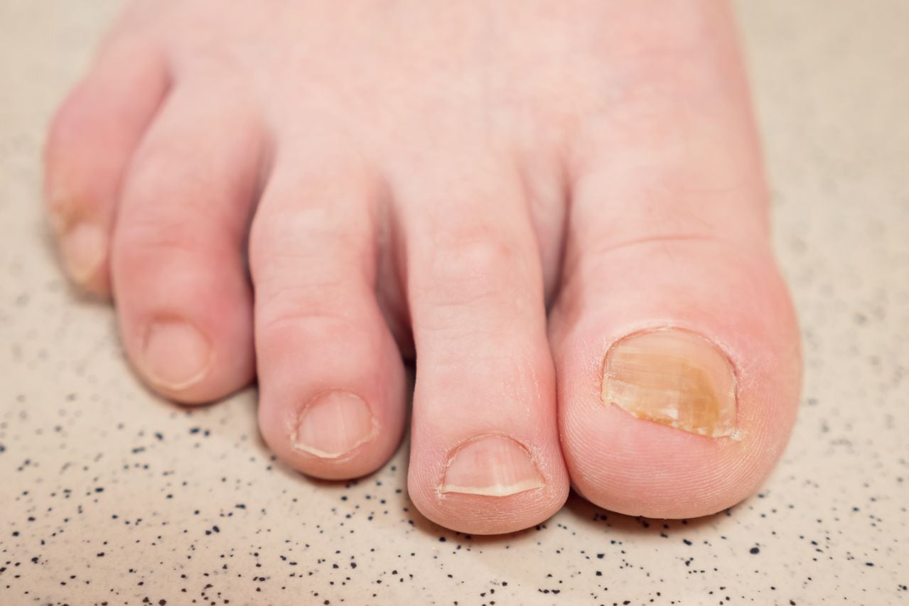 Las uñas amarillentas pueden ser producto de una afección o de una mala higiene.