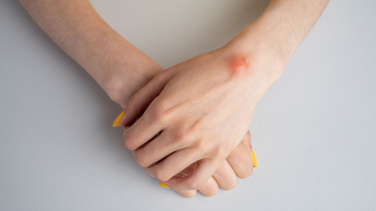La aparición de protuberancias en las manos requiere de atención médica.