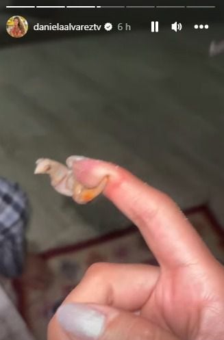 Un cangrejo le mordió el dedo a Daniela Álvarez. El animal escapó, pero la pinza se quedó agarrada de su mano.