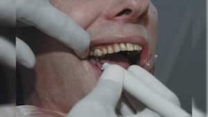 El sarro se produce por la acumulación de placa bacteriana.