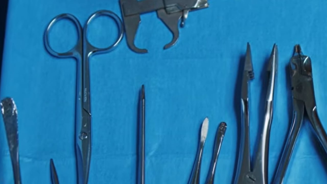 Mujer fue intervenida por tener tijeras en su abdomen.