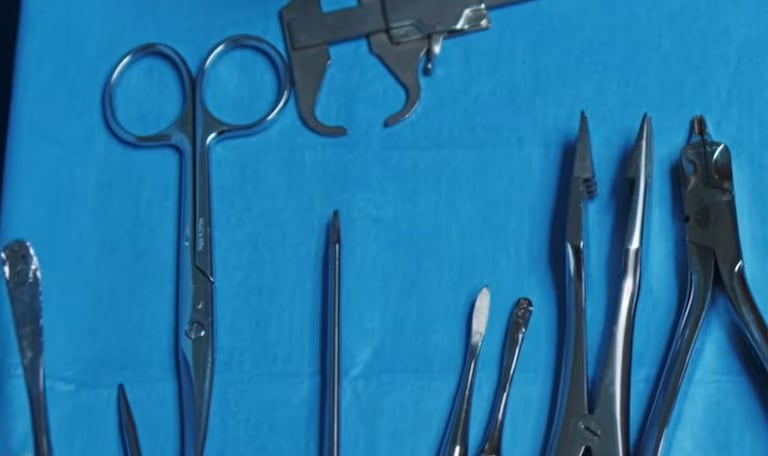Mujer fue intervenida por tener tijeras en su abdomen.