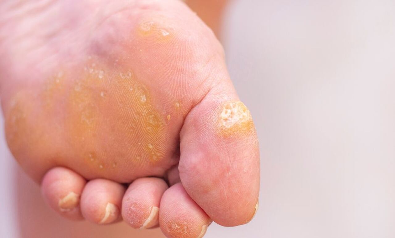 Ojo de pescado - verruga plantar