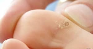 Hay varios tipos de verrugas que pueden aparecer en cualquier parte del cuerpo.