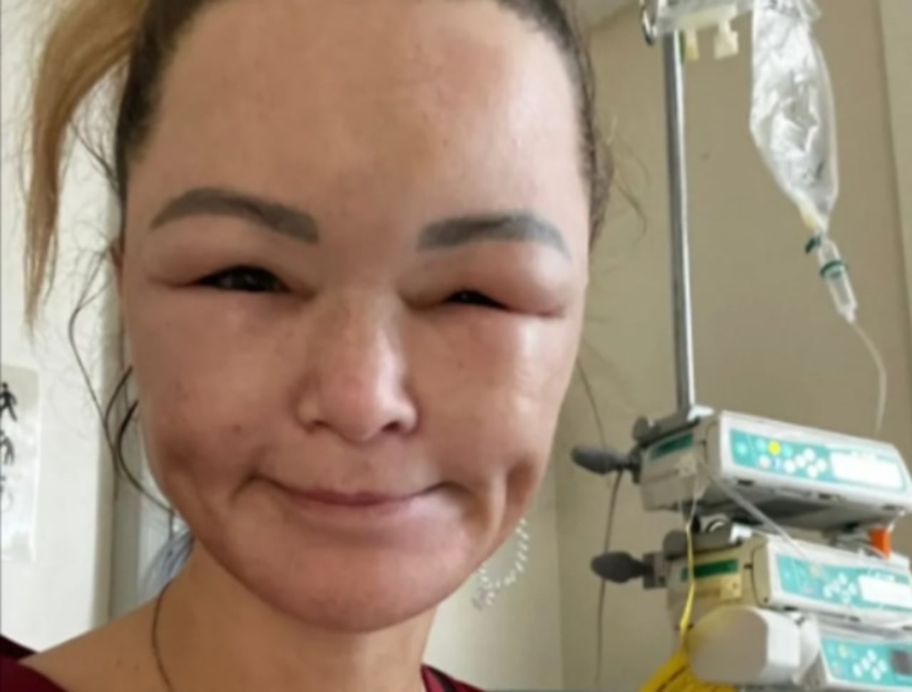 Enfermedad rara desfiguró su rostro tras un accidente: La historia de Claire Titterington.