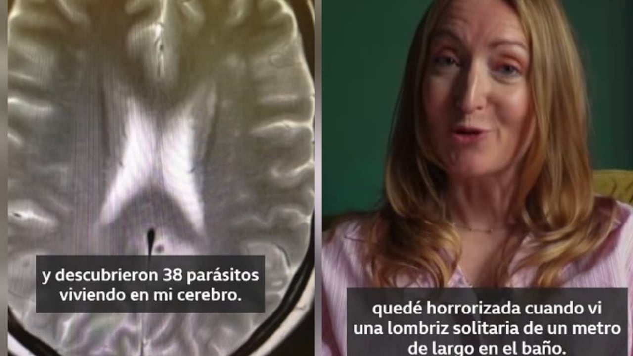 Mujer contó cómo una enfermedad parasitaria contraída en un viaje a India le provocó convulsiones y psicosis.