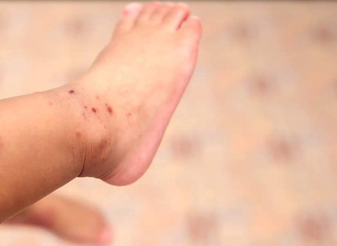 Para tranquilidad de los mayores esta infección es benigna