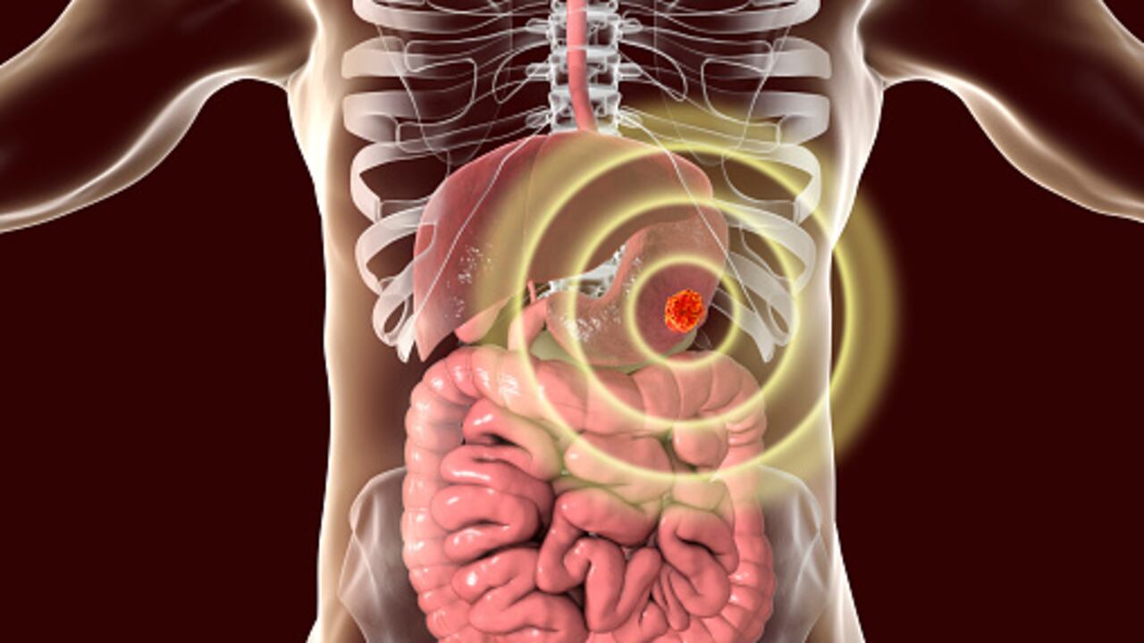 El cáncer de estómago empieza cuando las células en este órgano crecen de manera descontrolada.