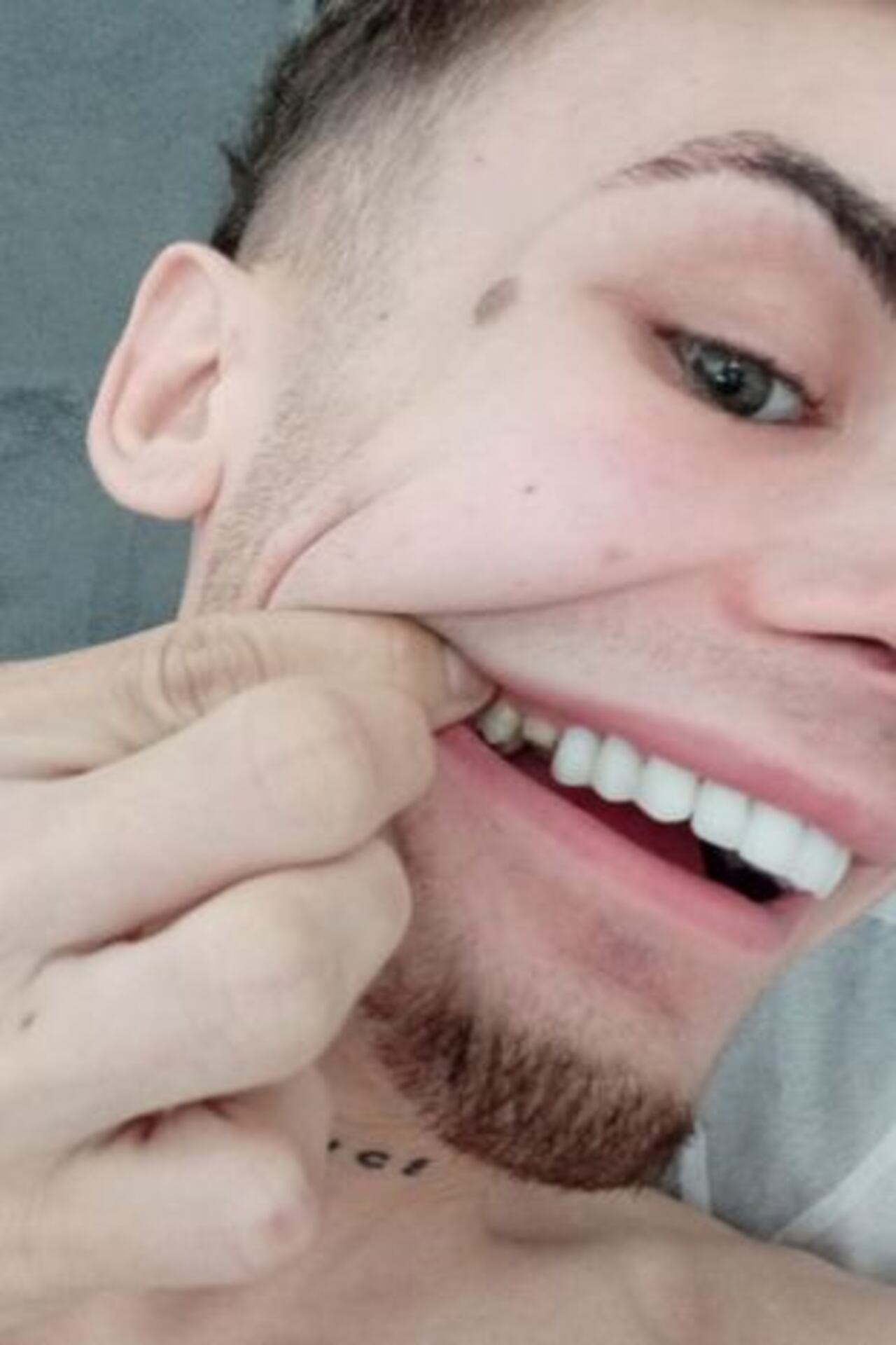 Las carillas se caían con facilidad.