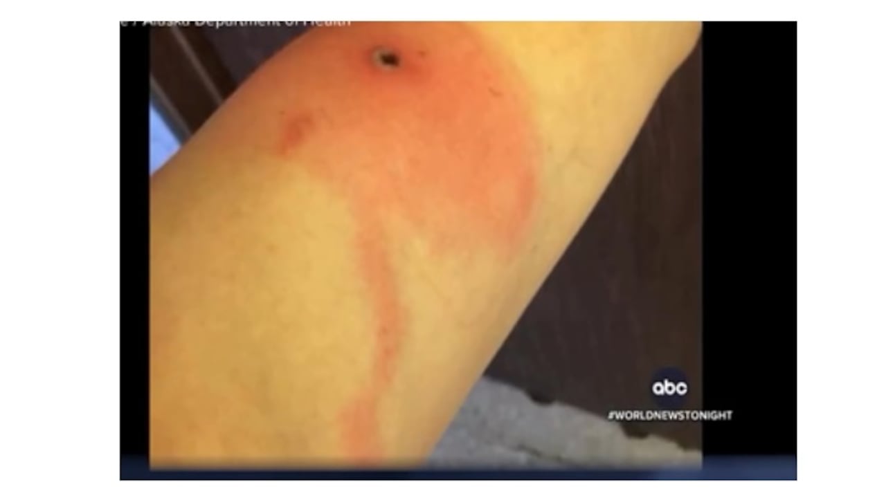 Todas tuvieron casos leves y se recuperaron sin tener que ser hospitalizadas.