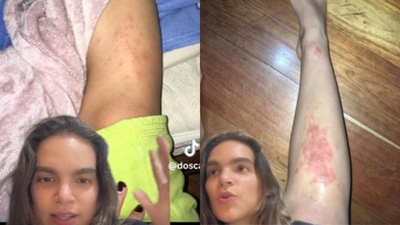 Muchos usuarios en TikTok compartieron experiencias similares luego de que la joven contara que le dio un parásito.