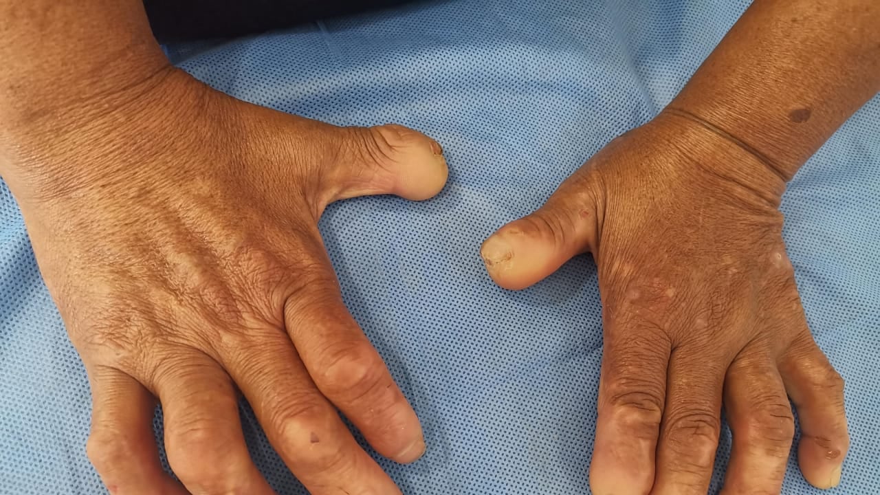 La deformidad en los dedos desencadena en una discapacidad irreversible. Esta puede ir
evolucionando con el tiempo hasta afectar por completo la capacidad de agarre.
