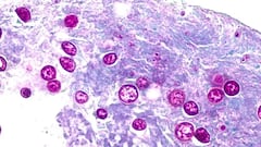 La ciclosporiasis es una enfermedad intestinal causada por el parásito Cyclospora cayetanensis.