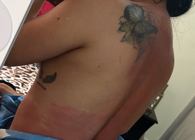 Según la afectada, el SPA omitió la valoración previa del tipo de piel, un paso obligatorio antes de iniciar el procedimiento de bronceado brasileño para evitar reacciones adversas.