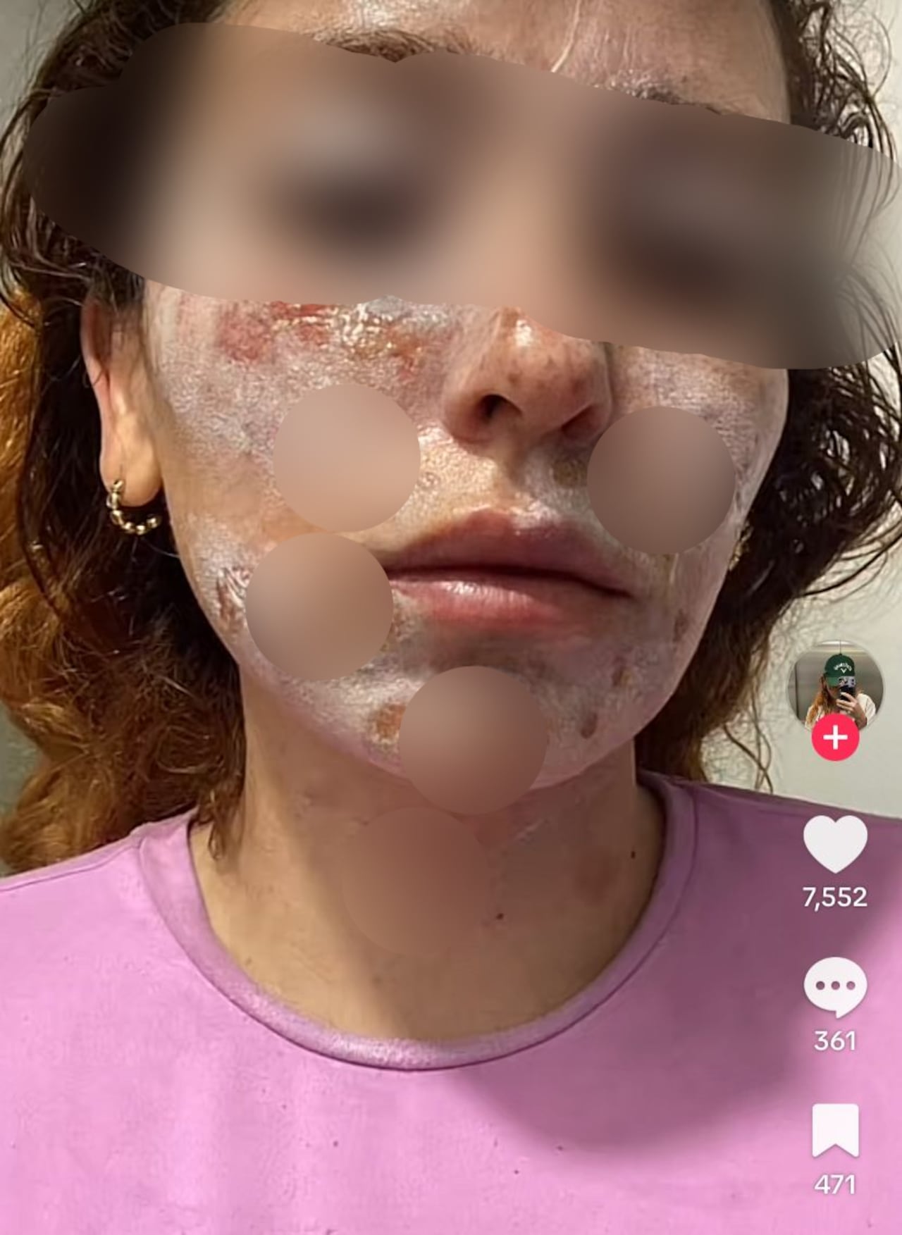 Vanessa Rada sufrió graves quemaduras en su rostro.