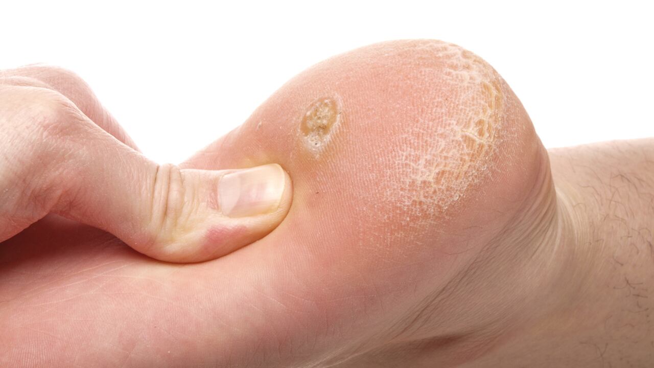 El ojo de pescado sale como una coloración amarillenta con uno o varios punticos negros en el medio