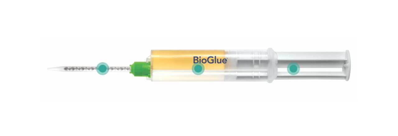 El adhesivo BioGlue® se emplea como complemento a los métodos tradicionales. (Imagen de referencia).