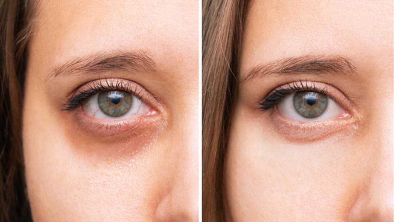 Las ojeras pueden aparecer por no dormir bien.