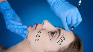 vista lateral del paciente, cirugía plástica, médico dibujando líneas de corrección.