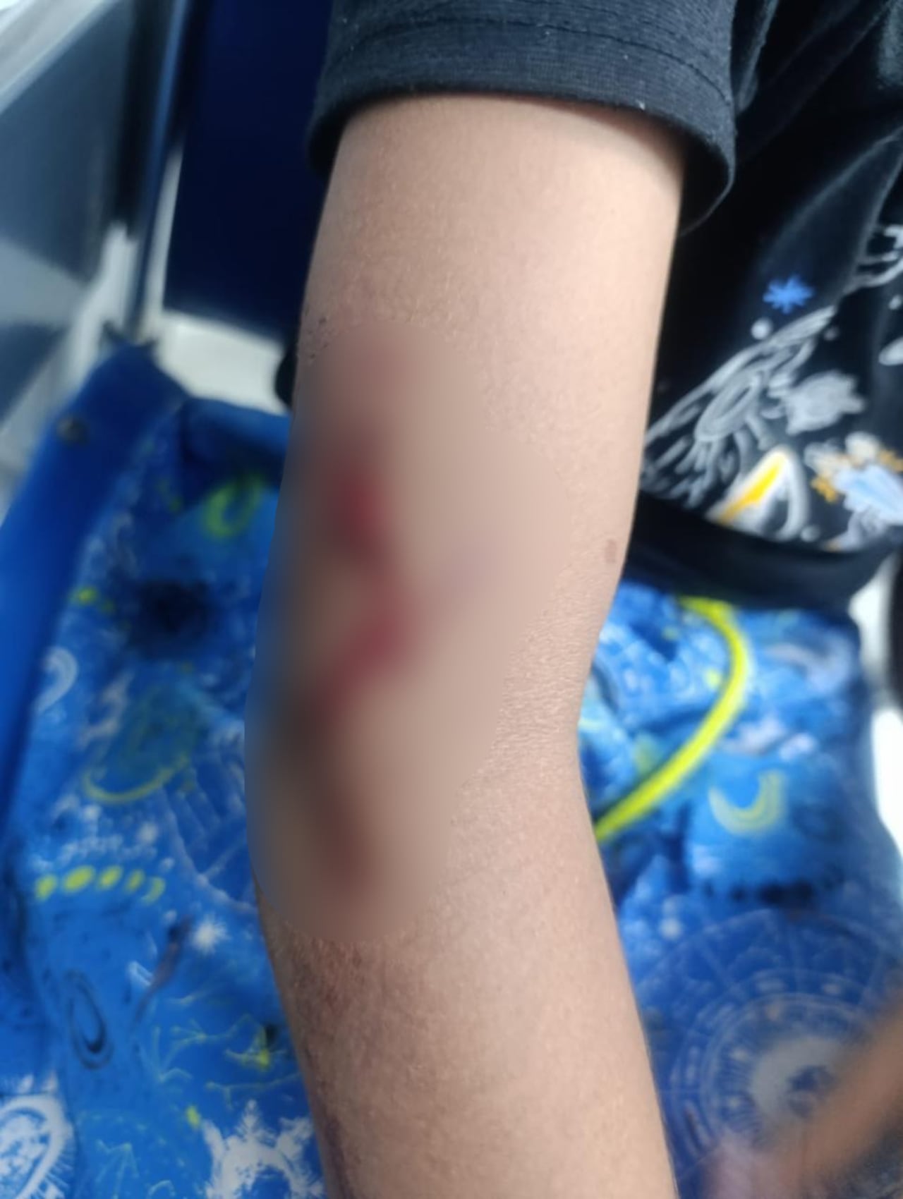 Los brazos y espalda del niño también resultaron con lesiones que requirieron suturas debido a la profundidad y extensión de las mismas.
